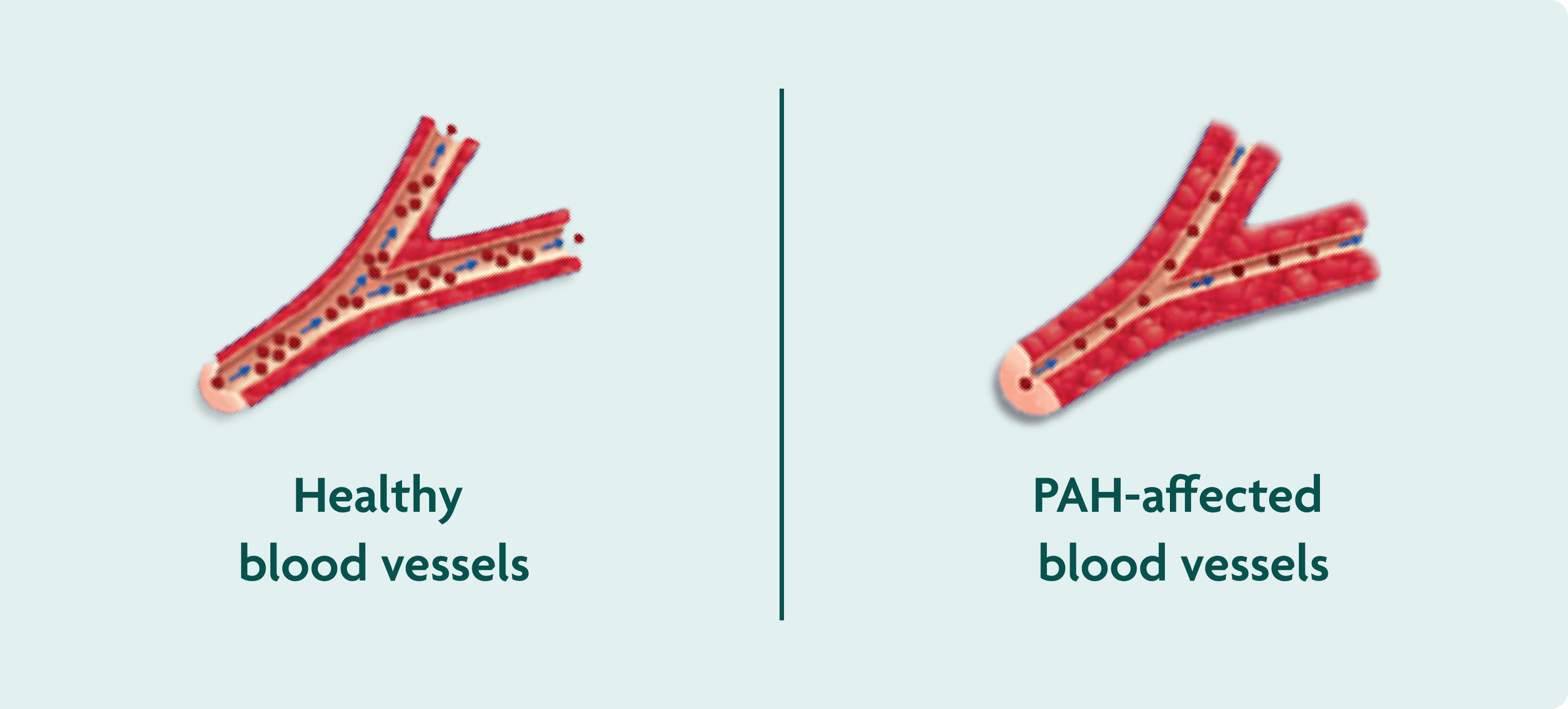 A healthy blood vessel compared to a blood vessel affected by PAH