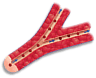 Illustration of a PAH-Affected Blood Vessel